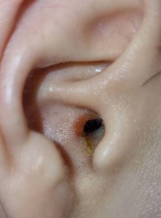 삼성 갤럭시 버즈 프로를 착용 후 외이도염에 걸렸다고 주장한 한 사용자가 올린 사진. /삼성멤버스 캡처