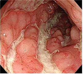 크론병 환자의 대장내시경 사진.