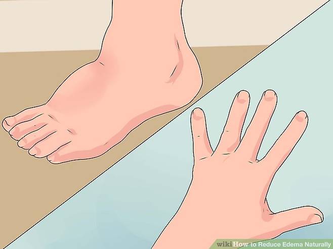 출처: https://www.wikihow.com/Reduce-Edema-Naturally