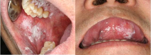 볼 안쪽 점막에 나타난 백색 반점(왼쪽)과 혀 아래 나타난 백색 반점과 적색 반점./사진=서울대치과병원 제공