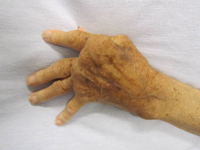 류마티스 관절염 환자의 손. 류마티스 관절염이 발생하면 염증으로 인해 혈액 내 백혈구들이 관절로 모여 들게 되고, 그 결과 관절이 부으면서 통증이 나타난다.