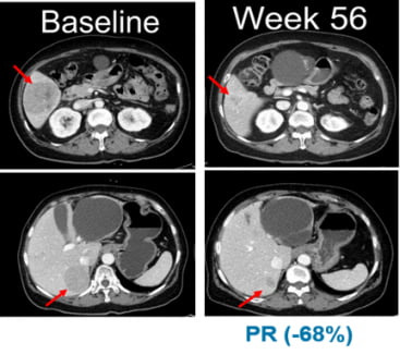 임상 시작 전(Baseline,좌측)과 벨바라페닙 투여 56주 후 흑색종 환자의 복부 CT사진. 사진 제공=한미약품