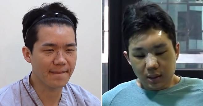 유튜브 채널 ‘보개미TV’를 통해 유튜버 보겸이 성형수술하는 모습을 공개했다. 유튜브 캡처