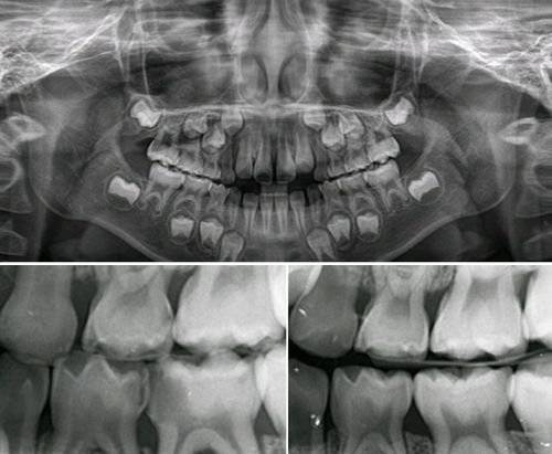 구외 파노라마 방사선 검사 사진(위). 우식증이 있는 방사선 사진(아래). [자료 전승준]