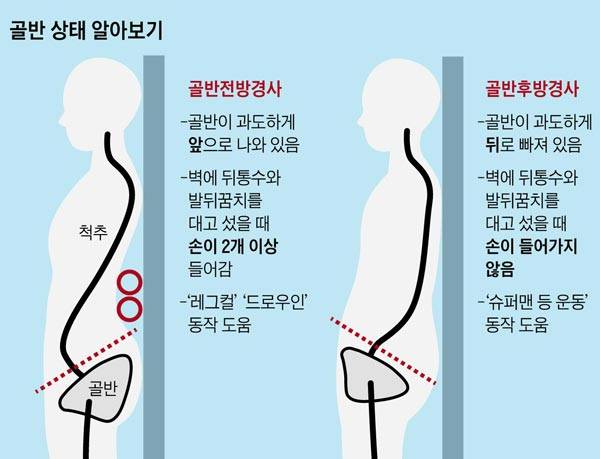 골반이 틀어진 방향 자가 진단법/사진=헬스조선 DB