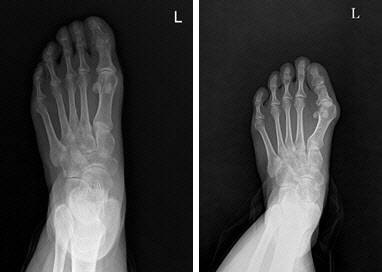 정상 발(좌)과 무지외반증 발(우) X-ray 비교.