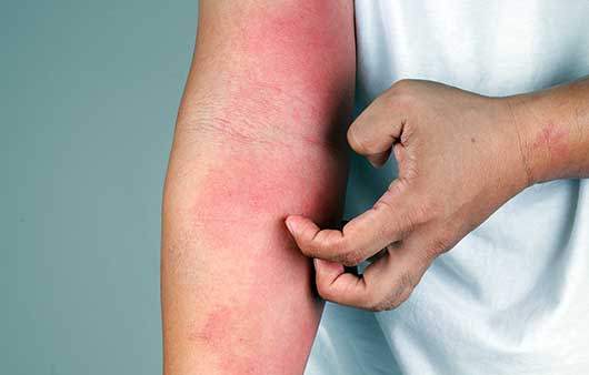 땀띠와 아토피는 비슷해 보여도 다른 증상이며, 관리와 치료방법에도 차이가 있다는 점을 기억하자