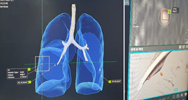 코어라인소프트의 의료 AI 솔루션은 3D 그래픽 상에 결절 부위를 표시해 보여주는 기능을 탑재했다. 그림 오른쪽은 실제 기자의 폐 결절 모양을 그대로 구현한 모습.