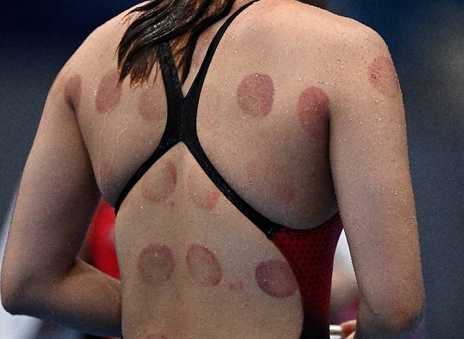 1일 열린 2020도교올림픽 수영종목에 출전한 한 선수의 등에 부항자국이 선명하게 새겨져 있다. [사진 = AFP연합]