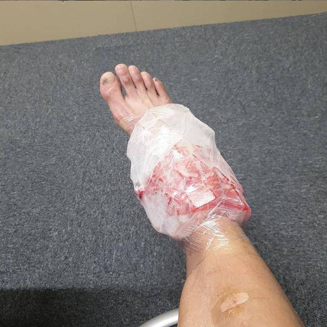 대한민국 팬싱 사브르의 오상욱이 개인전 16강에서 발목을 다친 후 얼음으로 통증을 식히고 있다. 오상욱 인스타그램