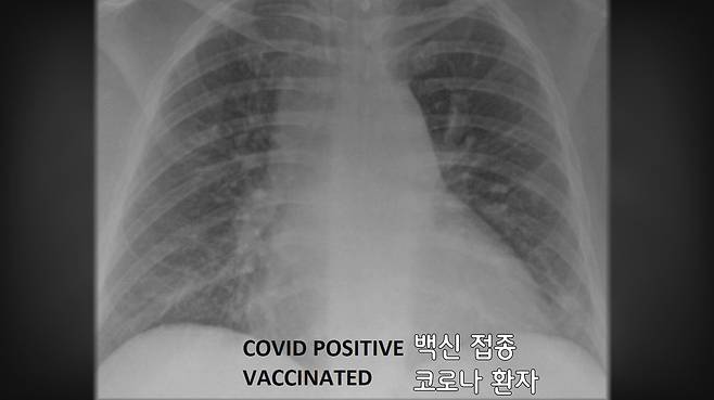 백신 접종 후 코로나19에 감염된 환자의 폐 X레이 사진