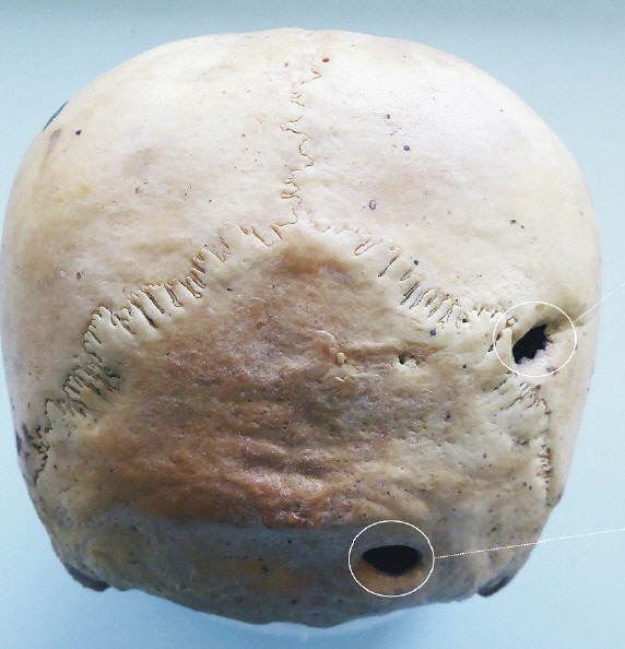 칠레 아타카마 사막의 신석기인 무덤에서 발견된 두개골. 뒤통수에 강한 충격을 받아 구멍이 나 있다.  칠레 타라파카대·미국 툴레인대 연구진 제공