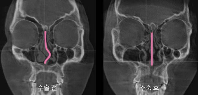 휘어있는 비중격과 수술 이후 곧아진 비중격 모습. 사진제공|아이디병원