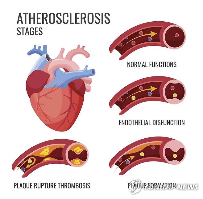 동맥경화 진행 단계 [게티이미지뱅크 제공]