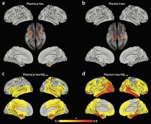 혈중 인산화 타우농도, 전체 타우 농도, 베타 아밀로이드 농도를 측정해 분석한 결과 혈중 전체 타우농도, 베타 아밀로이드 농도의 비율이 뇌 타우 축적과 가장 밀접한 연관성이 있음을 나타내는 그림: (a) 혈중 인산화 타우만으로 예측한 결과, (b) 전체 타우로 예측한 결과, (c) 인산화타우/베타 아밀로이드 농도로 예측한 결과, (d) 전체 타우/베타 아밀로이드로 예측한 결과. [사진 서울대]