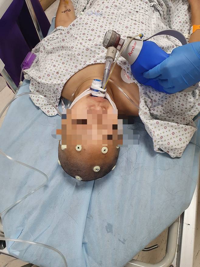 지난달 26일 화이자 백신 1차 접종을 받고 뇌출혈로 쓰러진 25세 A씨가 지난 12일 수술을 위해 부산시 동아대병원 수술대 위에 누워있다. A씨는 수술 일주일째인 19일 기준 의료진이 이름을 부르면 반응을 하지만 아직 의식이 없는 상황이다./사진=A씨의 아버지 이호익씨 제공.