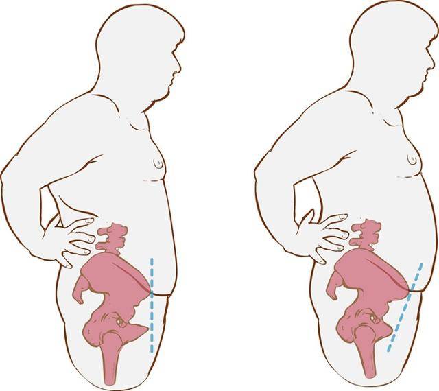 왼쪽 사진과 달리 오른쪽 사진의 경우 골반이 전방으로 기울어 있는데 이는 허리 통증을 유발한다. 게티이미지뱅크