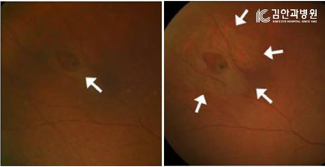 갑자기 심해진 비문증을 호소하며 안과를 방문한 환자의 망막 신경 모습.
