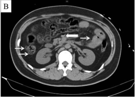 콜라 1.5리터를 10분 만에 마신 중국 남성의 CT 결과. 화살표는 장 등에 가스가 찬 모습을 가리킨다. [트위터 캡처]