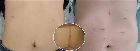 복강경으로 간이식 수술을 한 기증자(왼쪽)과 수혜자(오른쪽)의 상처. 원 안은 기존 개복으로 간이식 수술을 한 복부 상처.​​/서울대병원 제공