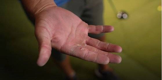 롱 드라이브 대회 연습 도중 손바닥에 잡힌 물집이 터진 디섐보. [사진 디섐보 유튜브 캡처]