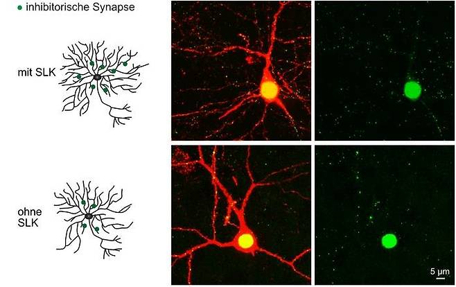 SLK 효소의 작용 아래 사진은 SLK가 결핍된 수상돌기.
SLK가 정상인 수상돌기(위)보다 가지가 적고, 억제 시냅스(녹색)도 감소했다.
[독일 본 대학 신경병리학 연구소 / 재판매 및 DB 금지]