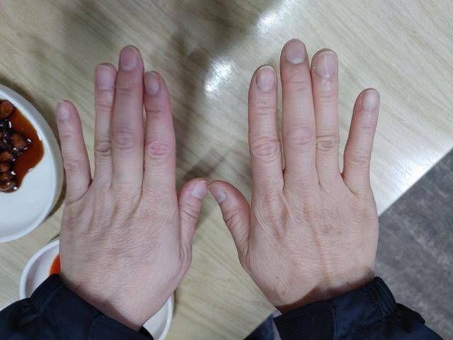 4년차 LG케어솔루션 방문점검원 김정원씨(56)의 손. 손가락 마디마디가 부어 있고, 약지와 새끼손가락 쪽에 관절 변형이 왔다. 매일 필터를 돌리고, 무거운 짐을 들며 관절염이 생겼다.