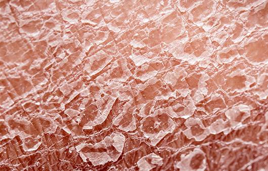 무좀은 흔하지만 가볍지 않은 질환이다. 감염성을 지녔기 때문이다