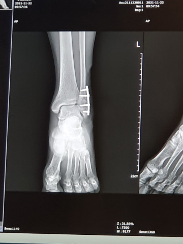발목 피로골절 부위 수술 후 엑스레이 사진.