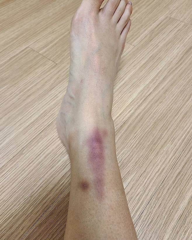 Broadcaster Oh Jeong-yeon has released a photo of his feet full of blood.On the 30th, Oh Jeong-yeon told SNS, I took my baggage in the morning to go to the soccer practice after shooting today, but I took two pants without my top and lent me the windshield that coach Jung Jong-bong was wearing.Thank you, he said, posting several photos.Oh Jeong-yeon said, Our coach Hyun Young-min said this.In the professional football world, few players play in perfect condition without any injuries ... lets endure the injuries we can afford, of course, be careful to always occur to the minimum!The more I get to know the ball, the more fun football is. I understand now why the boys are going out every lunchtime and going out to play soccer!Its a long life and a long time to live, he added.In the photo, Oh Jeong-yeon, who is practicing soccer, especially because he practiced soccer hard, he revealed his feet with bruises and worried about fans.On the other hand, Oh Jeong-yeon is appearing on SBS Shooting Girls.