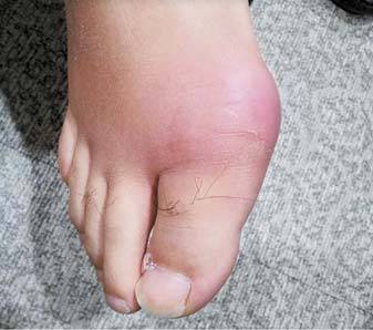 엄지발가락의 뿌리가 시작되는 발허리발가락 관절에 통풍으로 발적과 함께 심한 종창이 생긴 모습. [사진 대한류마티스학회]