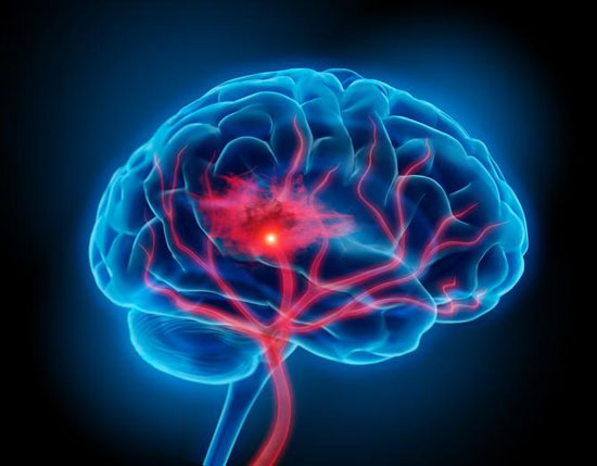 치매 예방약인 ‘콜린알포세레이트’가 뇌졸중 발생 위험을 높인다는 결과가 나왔다. (서울대학교병원 제공)