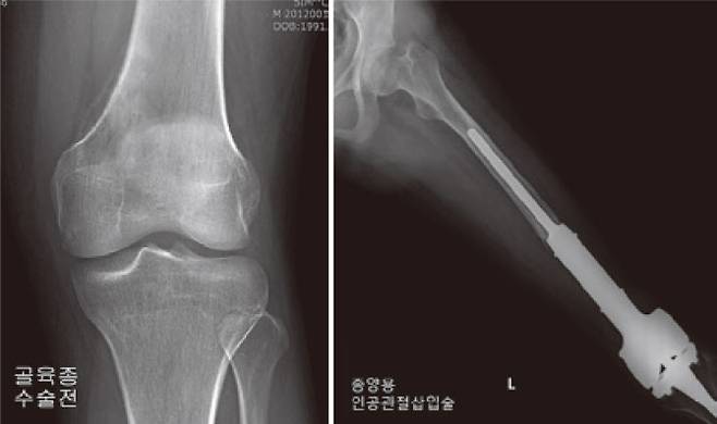골육종 수술전(왼쪽)과 종양용 인공관절삽입술.