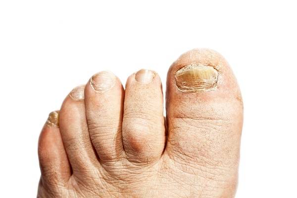 발톱 무좀이 발생하면 변형·탈색·분리·각질화 등의 증상이 나타난다./사진=클립아트코리아