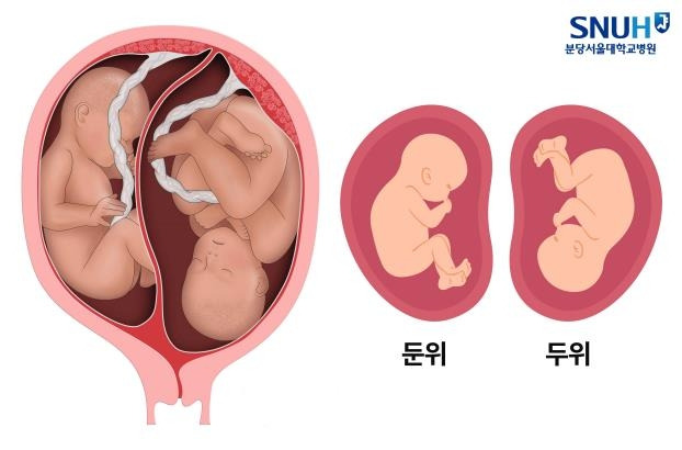 [분당서울대학교병원 제공. 재판매 및 DB 금지]