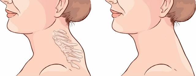 버섯목 증후군은 목덜미 아래 경추 7번 뼈 일부가 돌출돼 지방이 쌓여 볼록하게 솟아 오른 모습이다. (왼쪽이 버섯목 증후군, 오른쪽은 정상 모습)/사진=수원나누리병원 제공