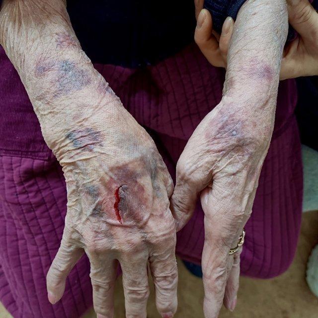 경북 김천시 한 노인주간보호센터에서 80대 할머니가 요양보호사 등에게 집단폭행을 당했다며 상처를 공개했다. 할머니 가족 제공