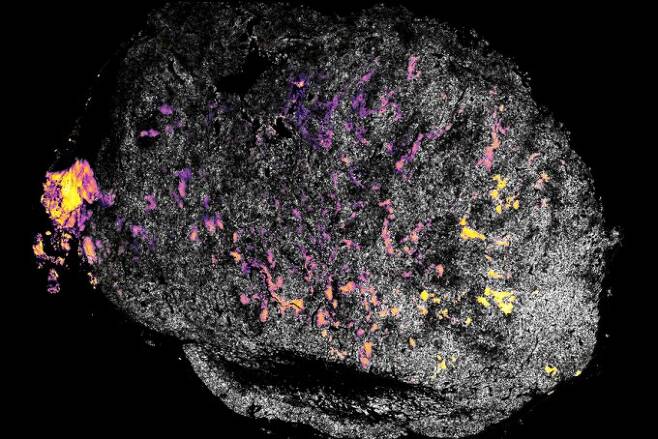 MIT 연구진이 사이토카인(IL-12)에 수산화 알루미늄을 결합한 단백질을 종양에 전달한 뒤 종양의 모습이다. 핑크색은 IL-12를 나타내고 노란색은 수산화 알루미늄이다. 종양에 달라붙은 IL-12가 종양 주변의 면역세포(T세포를) 활성화시키면 면역세포가 암세포를 공격하면서 치료가 이뤄진다. MIT 제공.
