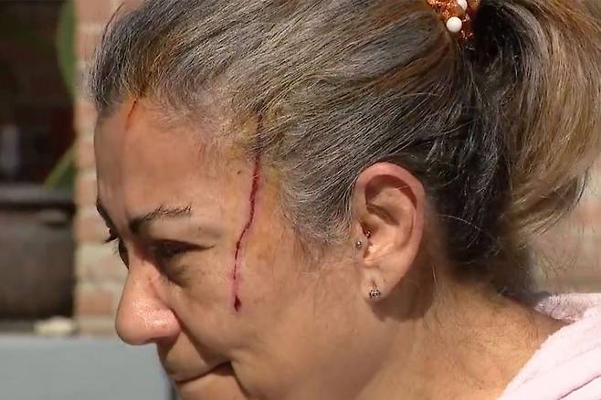 자신의 이름을 에이디라고 밝힌 여성은 얼굴을 다친 것 외에도 곰의 이빨에 물리고 넘어질 때 머리를 부딪쳐 뇌진탕 증세도 보였다.(사진=폭스뉴스)
