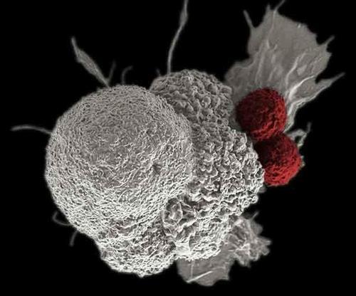 암세포를 공격하는 T세포 구강 편평상피 암세포(백색)를 공격하는 두 개의 세포 독성 T세포(적색)
[미국 국립 암 연구소(NCI) 홈페이지 캡처. 재판매 및 DB 금지]