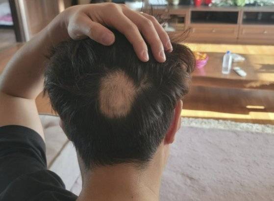 백신 접종 후 탈모 부작용을 호소한 A씨가 한 온라인 커뮤니티에 올린 사진. [사진=온라인 커뮤니티 캡처]