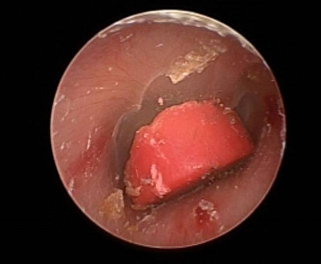 아이 귀 외이도에 꽂혀있는 플라스틱 장난감 조각. 한림대동탄성심병원 제공