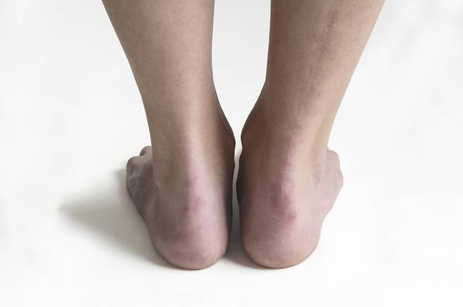발뒤꿈치. 게티이미지뱅크
