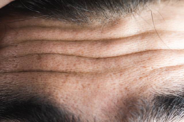 이마 주름 깊다면 심혈관질환 발병 위험이 높다는 신호일 수 있다./사진=게티이미지 뱅크