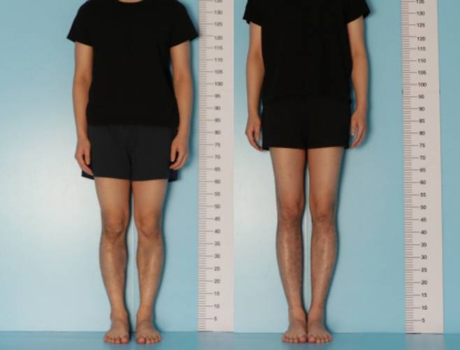 20대 남성의 종아리와 허벅지 '골 연장수술' 전후 모습. 종아리만 연장하면 평균 6㎝, 종아리와 허벅지를 동시에 연장하면 평균 8~12㎝ 키가 커진다. [이동훈연세정형외과 제공]
