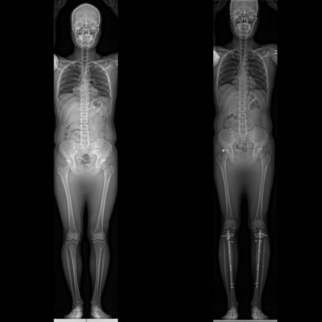 내고정 장치를 사용하는 ‘프리사이즈’ 수술을 한 환자의 전후 모습. 수술 후 사진(오른쪽)에서 종아리에 내고정 장치가 있는 것을 확인할 수 있다. [이동훈연세정형외과 제공]