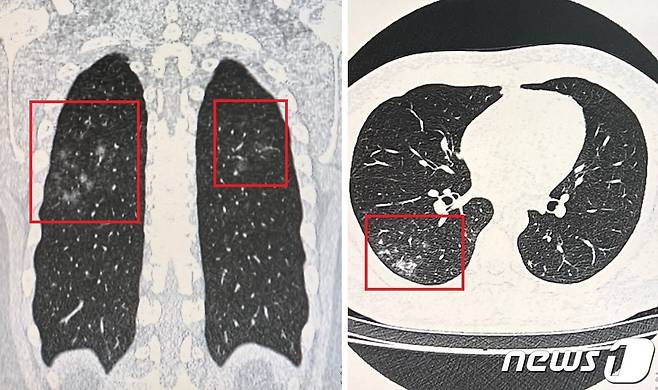 코로나 후유증 클리닉에 폐렴 진단을 받았다. 폐의 세로 단면 CT 사진(왼쪽)과 가로 단면 CT 사진. 뿌옇게 번진 부분이 폐렴이 나타난 부위라는 설명을 받았다. 2022.04.14./뉴스1 © News1 김정현 기자