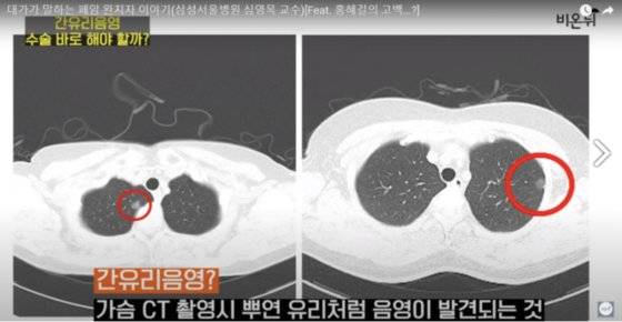 홍혜걸씨의 폐 CT 촬영 사진. 빨간색 동그라미 부분이 간유리음영. [유튜브채널 '의학채널 비온뒤' 캡처]