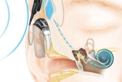인공와우가 소리를 전기신호로 변환해 달팽이관에 전달하는 원리. 코클리어코리아 제공