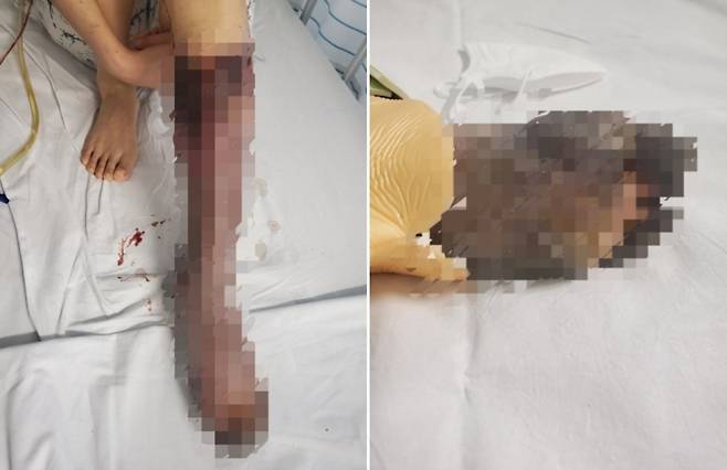 3일 네이트판에 혈전 부작용으로 다리를 절단한 A씨의 친구가 올린 사진. [온라인 커뮤니티]